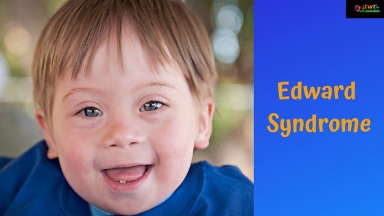 Edward Syndrome | Signs and Symptoms of Edward syndrome