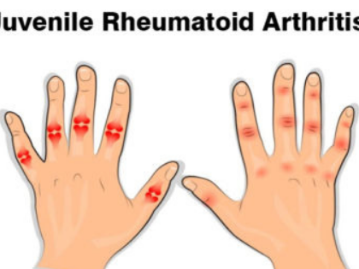 Juvenile Rheumatoid Arthritis