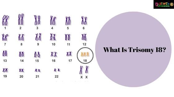 What Is Trisomy 18 | Edwards Syndrome | Types Of Trisomy 18